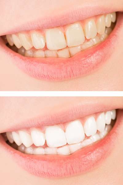 before and after images of teeth after they had whitening treatment